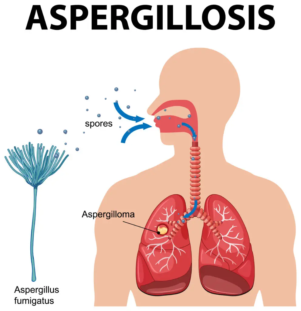 Diagram showing aspergillus infection