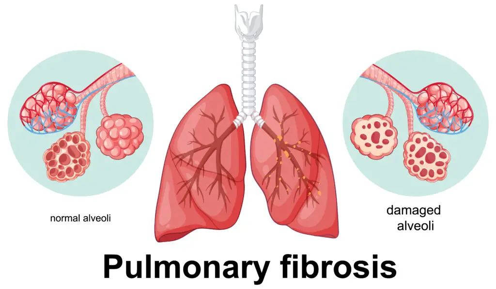 Pulmonary Fibrosis